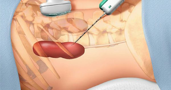 Kidney Stone Evaluation